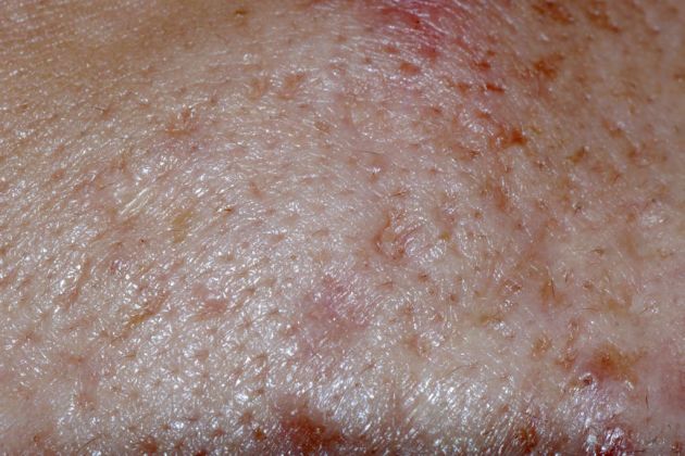 Epidermolisis